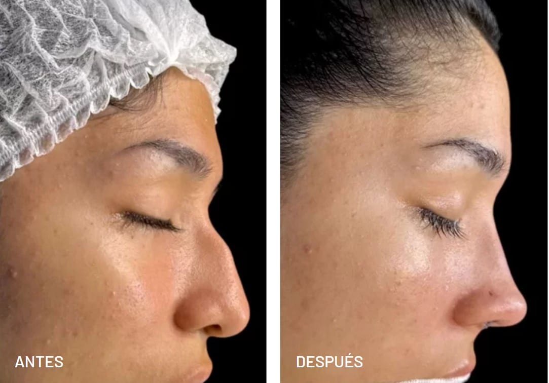 Rinoplastia caso 7 — antes y después